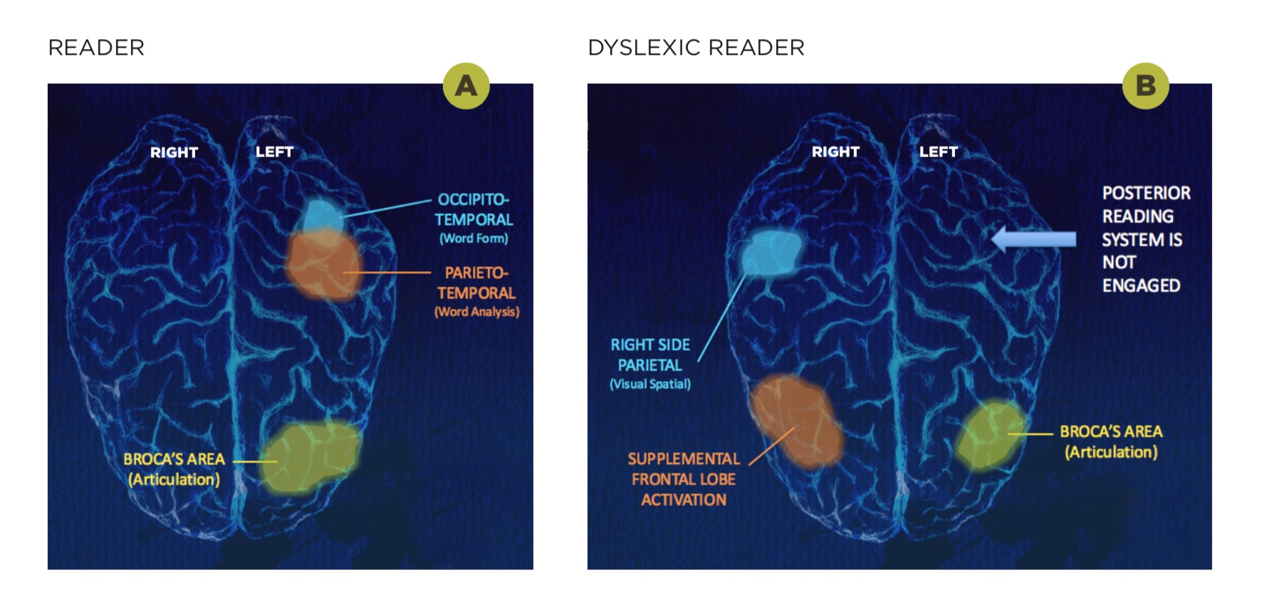 what-is-dyslexia-definition-and-what-dyslexia-looks-like